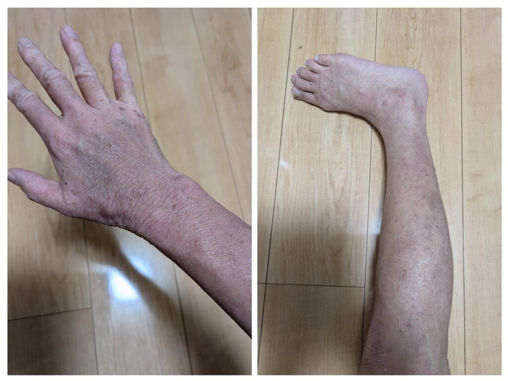 手と足のアトピーの写真