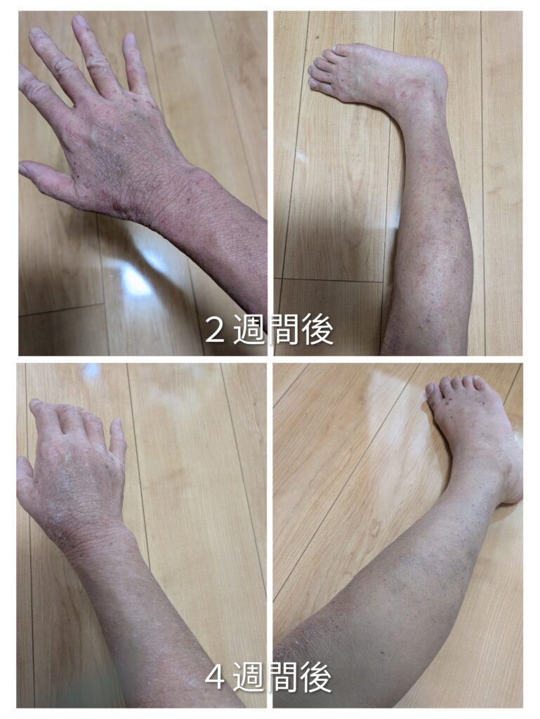 手と足の２週間後と４週間後のアトピー比較写真